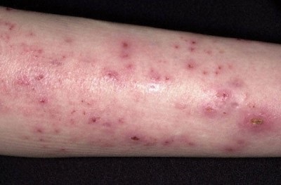dermatita varicoasa pe picioarele membrelor inferioare tratate Lipodermatosclerosis piciorului inferior (extremitati) dermatita varicoasa pe picioarele membrelor inferioare tratate Lipodermatosclerosis shin