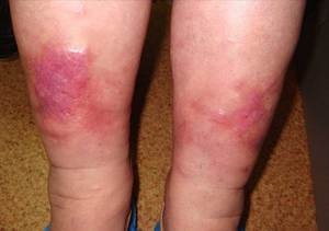 Dermatita de staza: cauze, simptome, tratament
