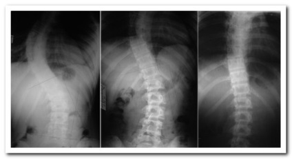 In scolioză special de 3 grade (fiecare exercițiu ales) In scolioză special de 3 grade
