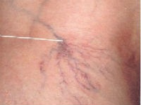 Au intervenit încheieturi cauze ale venelor umflate și umflături, cum să le eliminați (vene) Au intervenit încheieturi cauze ale venelor umflate și umflături, cum să le eliminați