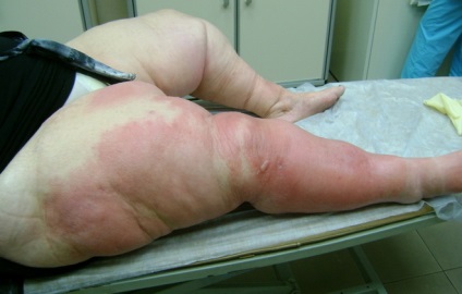 picioare pielii inflamate prin metode de tratament varice (piele) picioare inflamate pielii cu metodele de tratament varice