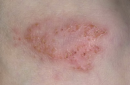 picioare inflamate varice metode de tratament (afectarea scurgere venos) picioare inflamate pielii cu metodele de tratament varice