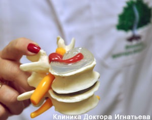 spinal reducerea discurilor »spine❺ (coloana vertebrală) spinal reducere discuri »spine❺