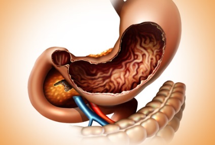 Tot ce trebuie sa stii despre stomac (gastric) Tot ce trebuie sa stii despre stomac