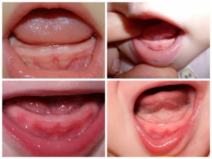 Toate simptomele de erupția dinților, nasului local și general infundat si tuse, hematom și diaree (semne de erupția dinților la sugari) Toate simptomele de dentitie locale și generale, secreții nazale și tuse, diaree și hematom