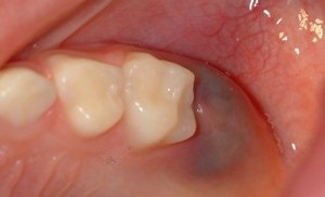 Toate simptomele de dentitie locale și generale, secreții nazale și tuse, hematom și diaree (simptome de dentitie pentru copii) Toate simptomele de dentitie locale și generale, secreții nazale și tuse, diaree și hematom