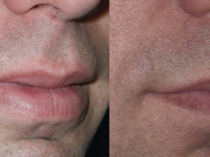Chiloplasty ce fel de operație, indicații de buze de plastic, avantajele și dezavantajele (chiloplasty fotografie ea după buze de plastic) Chiloplasty ce fel de operație, indicații pentru buze din plastic, avantaje și dezavantaje