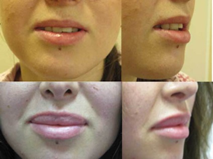 Chiloplasty ce fel de operație, indicații pentru buze din plastic, avantajele și dezavantajele (demnitate) Chiloplasty ce fel de operație, indicații pentru buze din plastic, avantaje și dezavantaje
