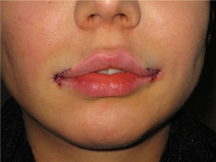 Chiloplasty ce fel de operație, indicații de buze de plastic, avantajele și dezavantajele (chiloplasty fotografie ea după buze de plastic) Chiloplasty ce fel de operație, indicații pentru buze din plastic, avantaje și dezavantaje