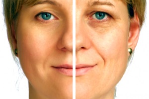 Peeling chimic tipuri faciale, indicații, în special (acele) Peeling chimic tipuri faciale, indicații, în special