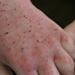 Cronica eczeme - diagnostic, tratament, foto (diagnosticare) Eczeme cronice - diagnostic, tratament, fotografii
