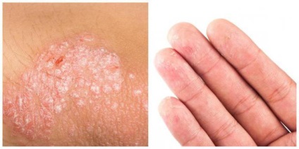 eczeme cronice cauze, simptomele și tratamentul (cronic) eczema cronica cauze, simptome și tratament