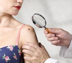Protecția de alunițe de la expunerea la soare la ultraviolete (soare) Protecția de alunițe de la expunerea la soare la ultraviolete