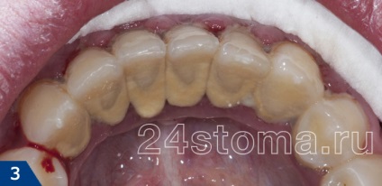 detartraj, stomatologie