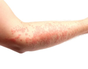 Alergia la frig cauze, simptome, tratament si prevenire