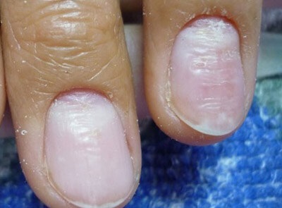 Неравности по ноктите е защо ноктите стават неравни и как да се отнасяме