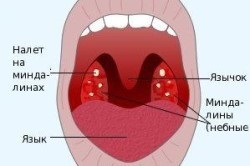 Decompensate simptome amigdalite cronice si tratament