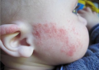 eczeme Infantile (eczeme) eczeme Pat