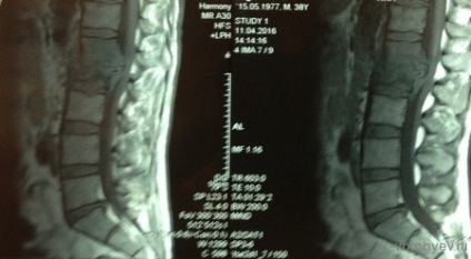 Discitis coloanei vertebrale, neurochirurgie (anevrisme) Discitis coloanei vertebrale, neurochirurgie