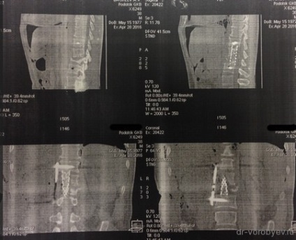 Discitis coloanei vertebrale, neurochirurgie (chirurgie pe creier în Podolsk) Discitis coloanei vertebrale, neurochirurgie