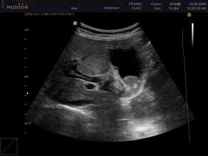 Cifrele normale abdominale Uzi, examinare de rinichi, glande, ficat și alte (normale) Cifrele normale abdominale Uzi, examen de rinichi, glande, ficat și alte