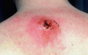 Aureus simptomelor de sânge și de tratament, modul de a trata, cauze, consecinte (Staphylococcus aureus) Aureus simptomelor de sânge și de tratament, modul de a trata, cauze, consecințe