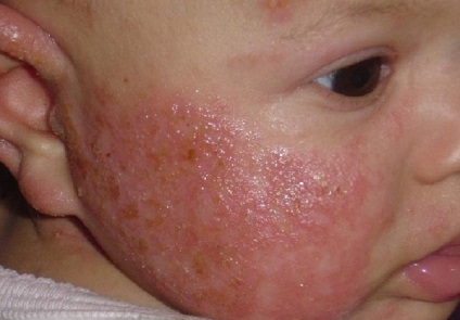 Aureus simptomelor de sânge și de tratament, modul de a trata, cauze, consecinte (Staphylococcus aureus) Aureus simptomelor de sânge și de tratament, modul de a trata, cauze, consecințe