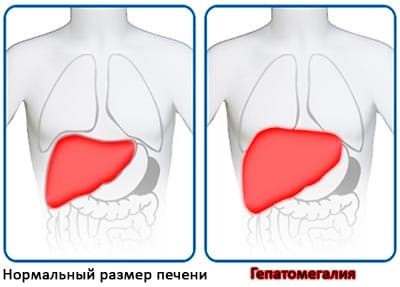 Creșterea ficatului (hepatomegalie) cauze, simptome și tratament