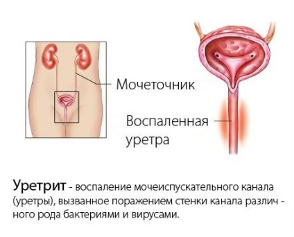 uretrita gonococica (gonorrheal) la bărbați și femei