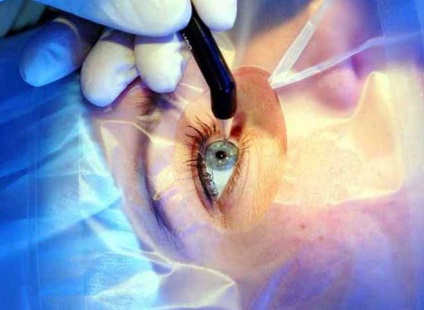 Keratoplastia (transplant de cornee)