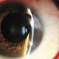 Keratoplastia sunt procedurile și rezultatele transplantului de cornee