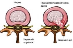 Tratamentul metode eficiente herniate