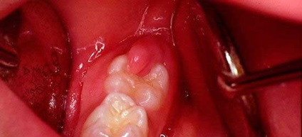 Pericoronitis cauze si tratament in clinica si acasa