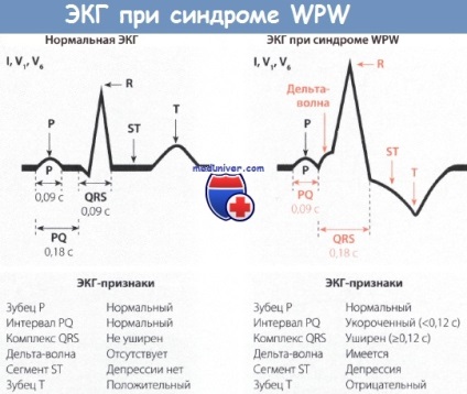 Признаци на Wolff-Parkinson-White (WPW) за електрокардиограма
