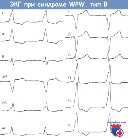 Признаци на Wolff-Parkinson-White (WPW) за електрокардиограма
