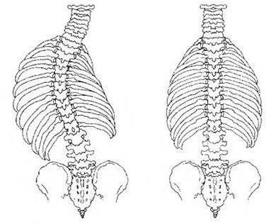 scolioză idiopatică juvenilă