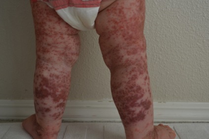 erupții cutanate alergice, cum să se ocupe cu ea (eczema, dermatita atopica) erupții cutanate alergice, cum să lupte