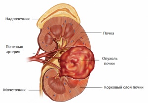angiomiolipom renală (pauză, apoi) angiomiolipom renală