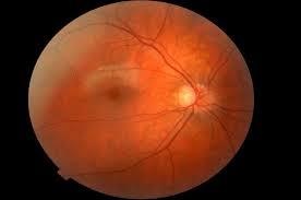 simptome angiopatia, tratament, descrierea (simptomelor) simptome angiopatia, tratament, descriere