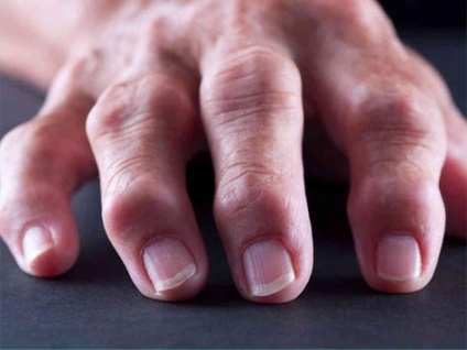Arthropathic descriere psoriazis, metode de tratare (tratament) Arthropathic descriere psoriazis, metode pentru tratarea