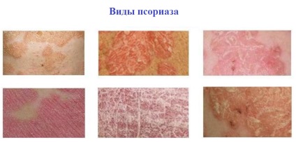 Arthropathic descriere psoriazis, metode de tratare (arthropathic) Arthropathic descriere psoriazis, metode pentru tratarea