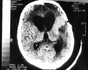 hidrocefalia Asymmetric și simptomele sale (ventricule cerebral) hidrocefalie asimetrica si simptomele sale