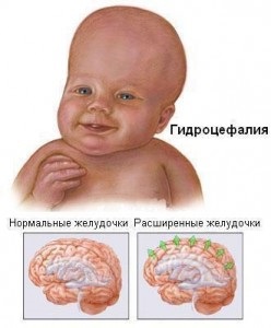 hidrocefalie asimetrica si simptomele sale (hidrocefalie) hidrocefalie asimetrica si simptomele sale