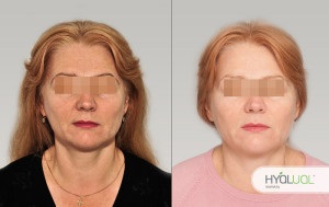 Biorevitalizare hyalual răspunsuri (gialual) la droguri (hyalual) hyalual Biorevitalizare (gialual) răspunsurile la droguri