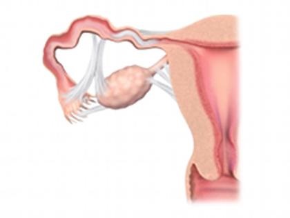 dureri abdominale inferioare la femei - o trăsătură caracteristică de inflamare a trompelor uterine (femei) dureri abdominale inferioare la femei - o trăsătură caracteristică de inflamare a trompelor uterine