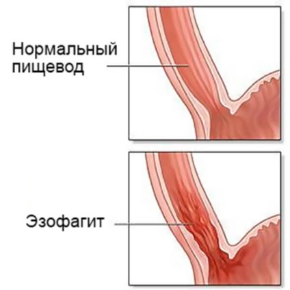 Durere în sternului drept la femei cauze, simptome și boli posibile (dreapta) Durere în sternului drept la femei cauze, simptome și boli posibile