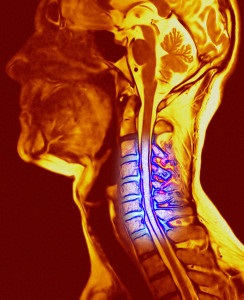 Колко опасен проблеми с шийката остеохондроза, техните симптоми и лечение