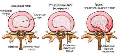 Ce face CT a coloanei vertebrale (coloana vertebrală) Ce face CT a coloanei vertebrale