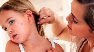 Ce este dermatita infectioasa - cauze, simptome si tratament (simptome) Ce este infecțioși dermatite - cauze, simptome și tratament