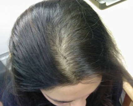 Difuze pierderea parului este ceea ce este, cauzele si tratamentul alopecie (căderea părului difuză este ceea ce este) Pierderea parului este Difuze ceea ce este, cauzele și tratamentul alopeciei
